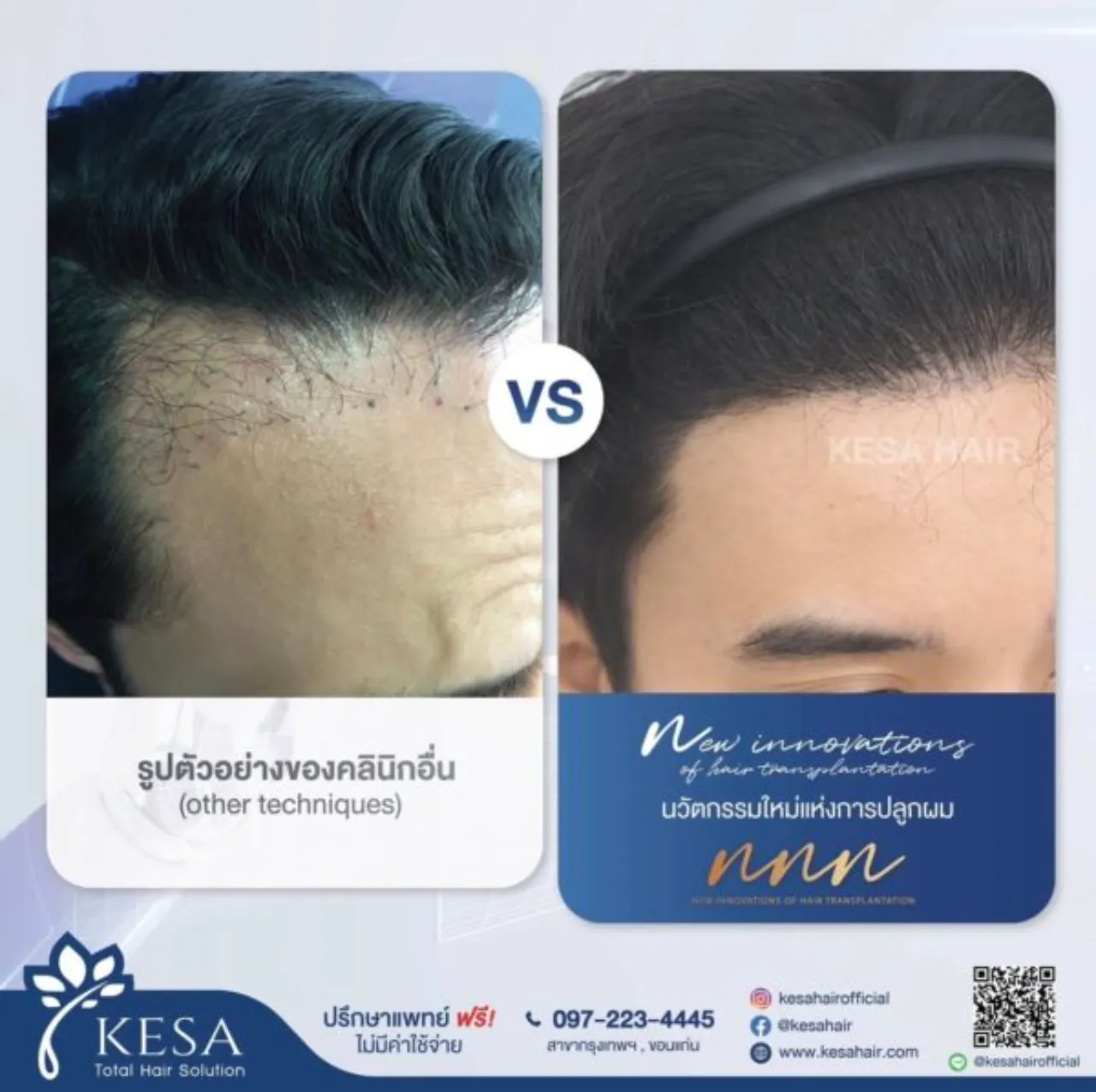 ทำไมปลูกผมแล้วไม่ขึ้น ศึกษาให้ดีก่อนตัดสินใจพลาด