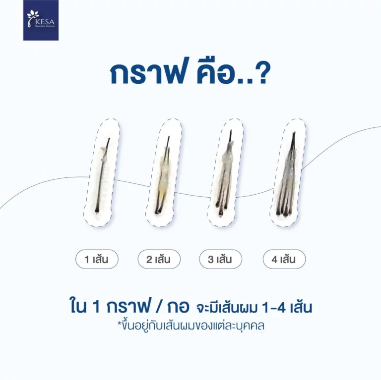 กราฟ คือ ? เกศา คลินิก - kesa hair clinic