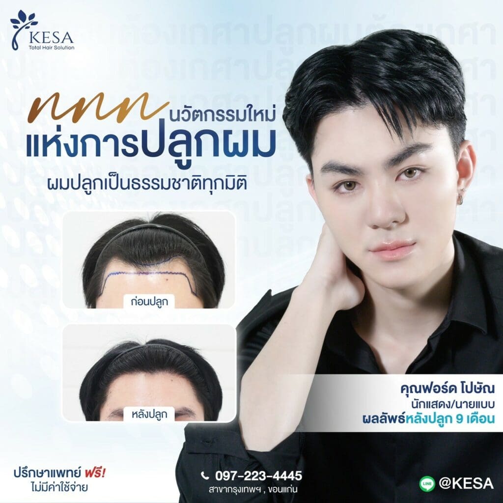 ปลูกผมราคา เกศา คลินิก - kesa hair clinic
