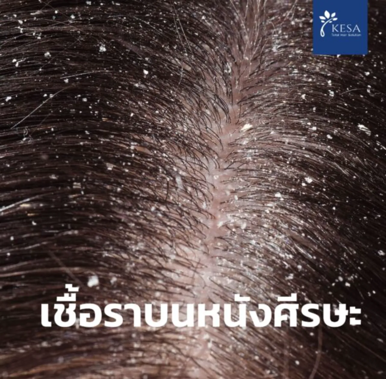 เชื้อราบนหนังศีรษะ เกศา คลินิก - kesa hair clinic