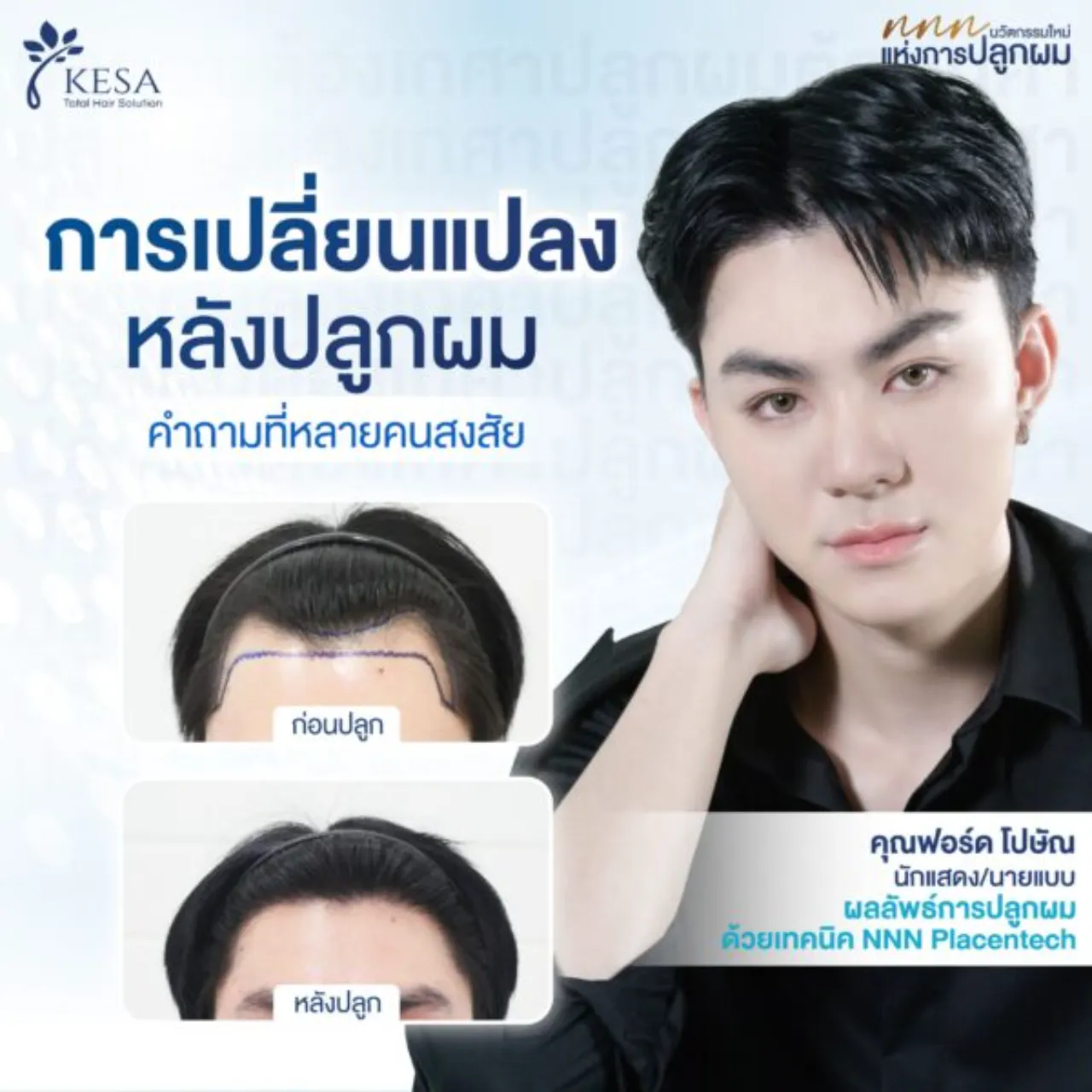 การเปลี่ยนแปลง หลังปลูกผม