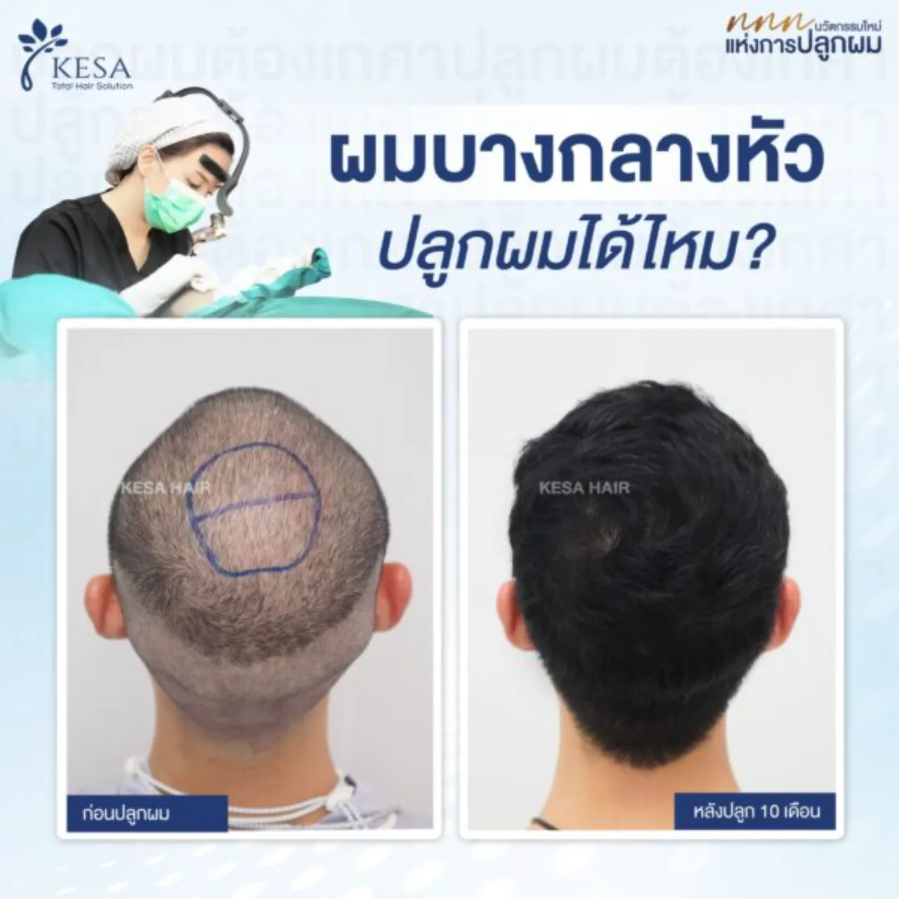 ปลูก ผม กลาง หัว