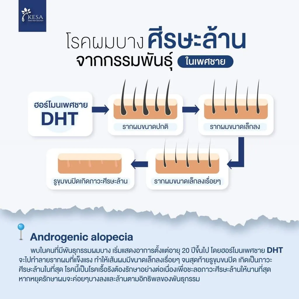 ศีรษะ ล้าน ผม บาง