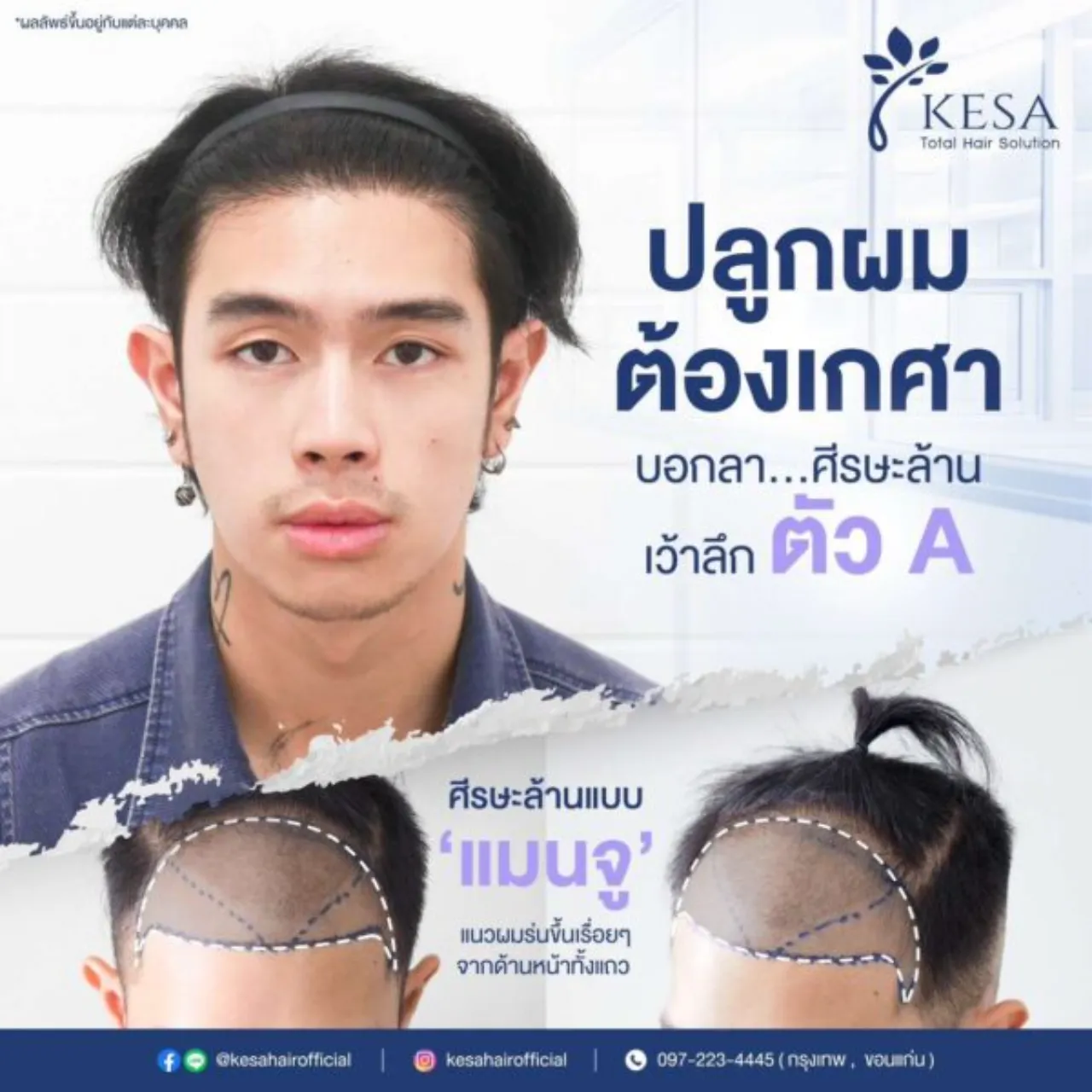 หัวล้าน ปลูกผม ได้ไหม ?
