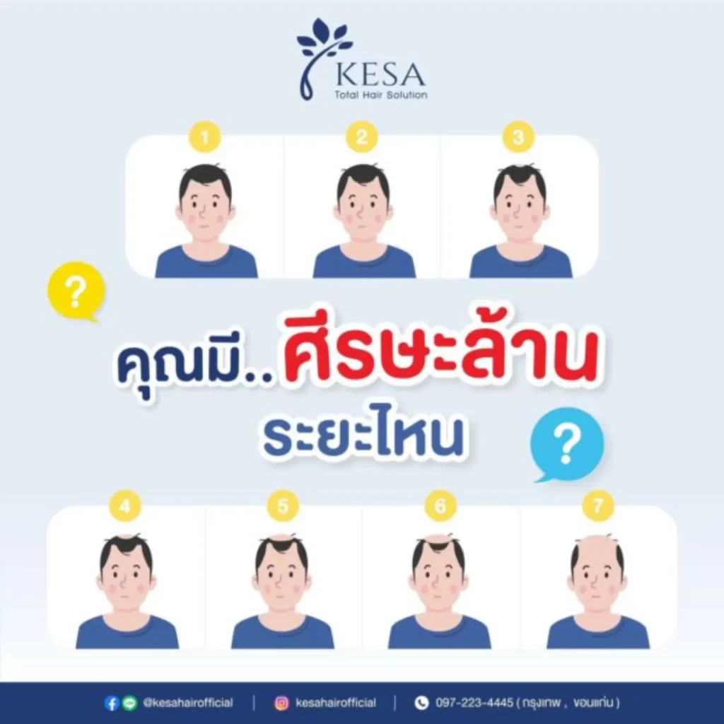 หัวล้าน ผู้ชาย มีกี่แบบ? เกศา คลินิก - kesa hair clinic