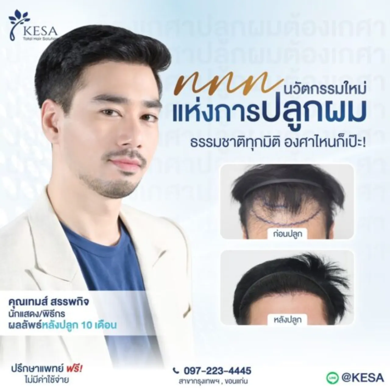 วิวัฒนาการ เทคนิคปลูกผม เกศา คลินิก - kesa hair clinic