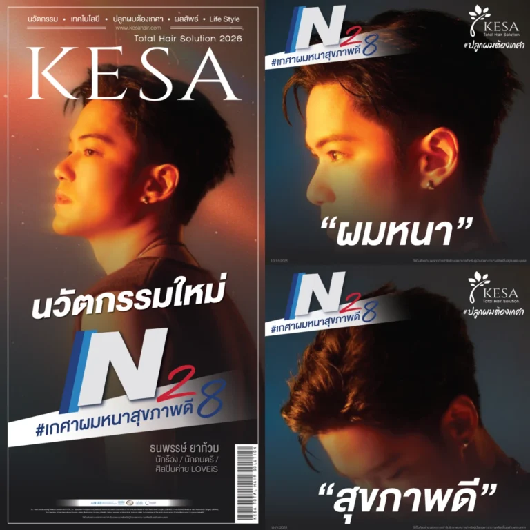 N8 รีวิวปลูกผมผู้ชาย