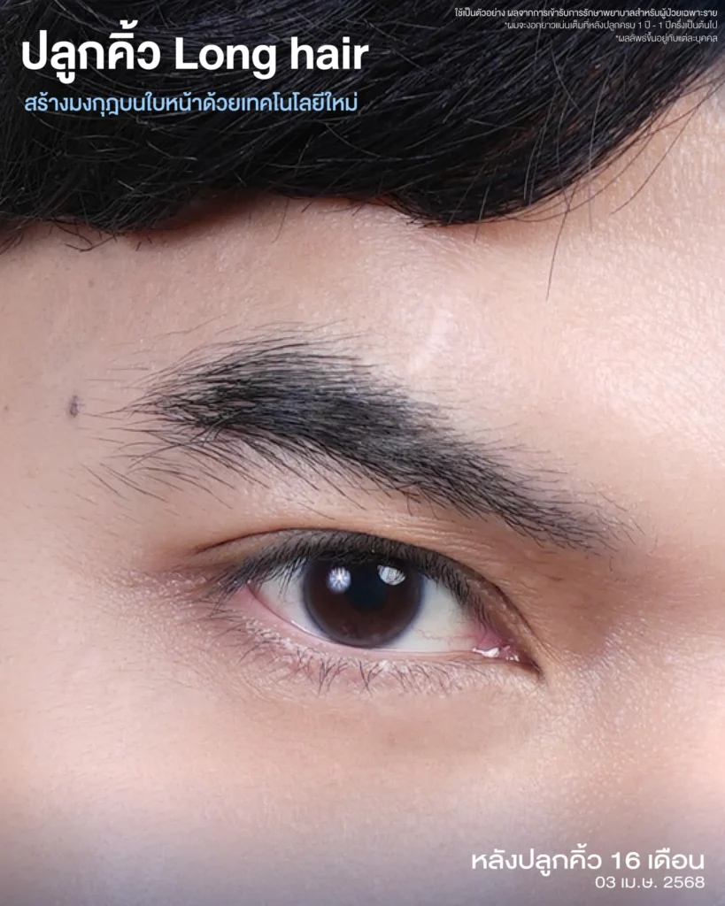 ปลูกคิ้ว ที่เกศา