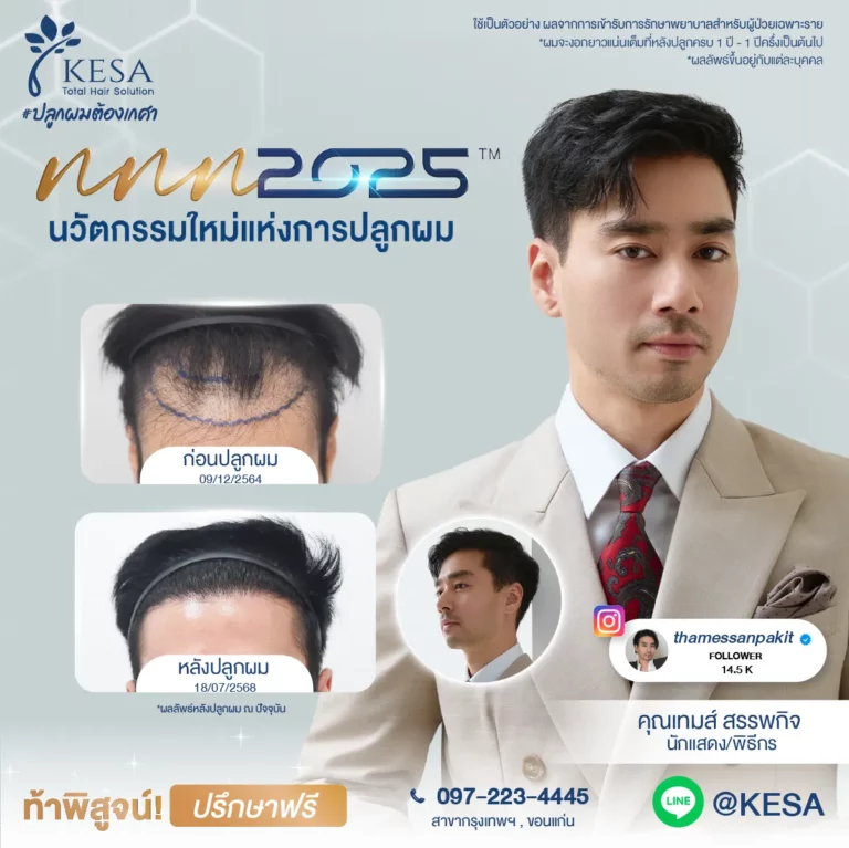 ปลูกผม ผู้ชาย