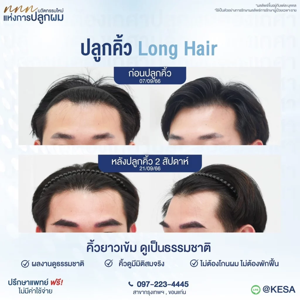ปลูกคิ้ว ที่เกศา
