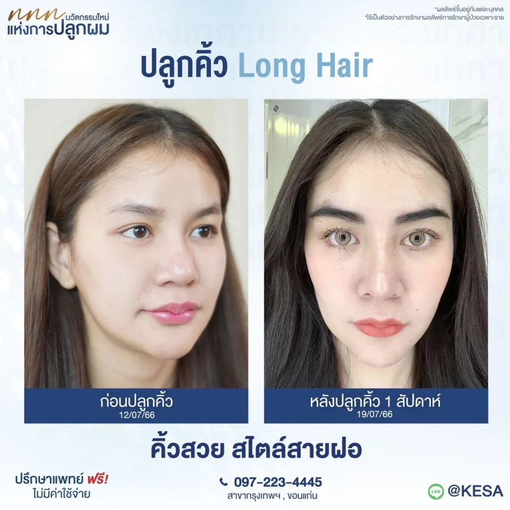 ปลูกคิ้ว ที่เกศา
