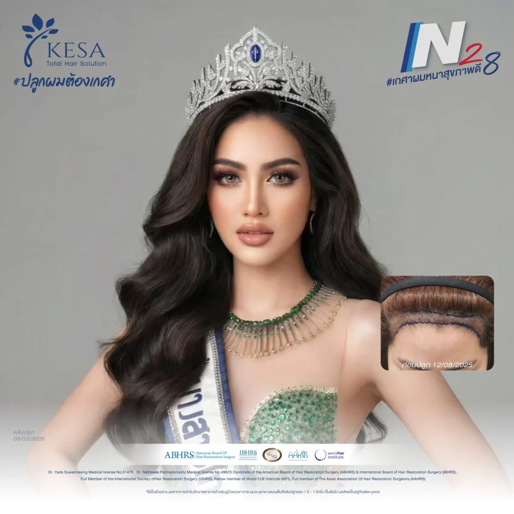 ปลูกผมผู้หญิง เกศา คลินิก - kesa hair clinic