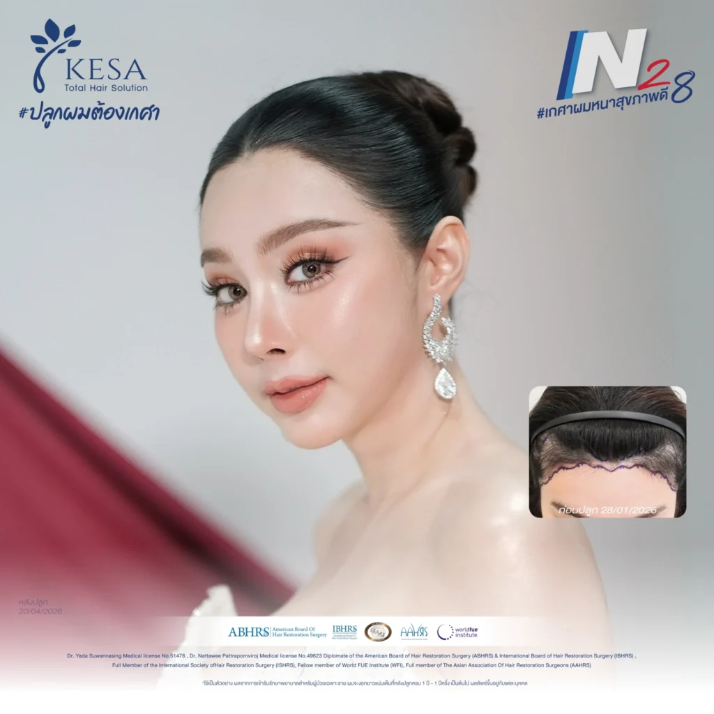 ปลูกผมผู้หญิง เกศา คลินิก - kesa hair clinic