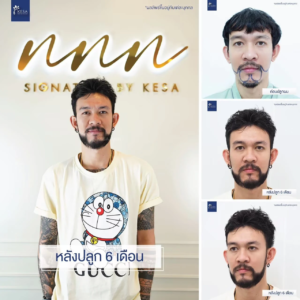 รีวิวปลูกหนวด