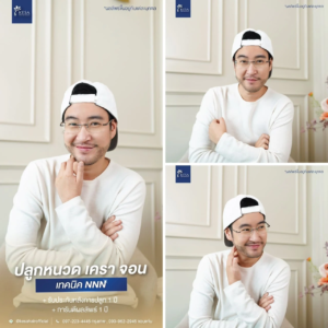 รีวิวปลูกหนวด