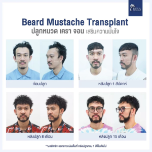 รีวิวปลูกหนวด