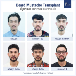 รีวิวปลูกหนวด