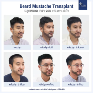 รีวิวปลูกหนวด