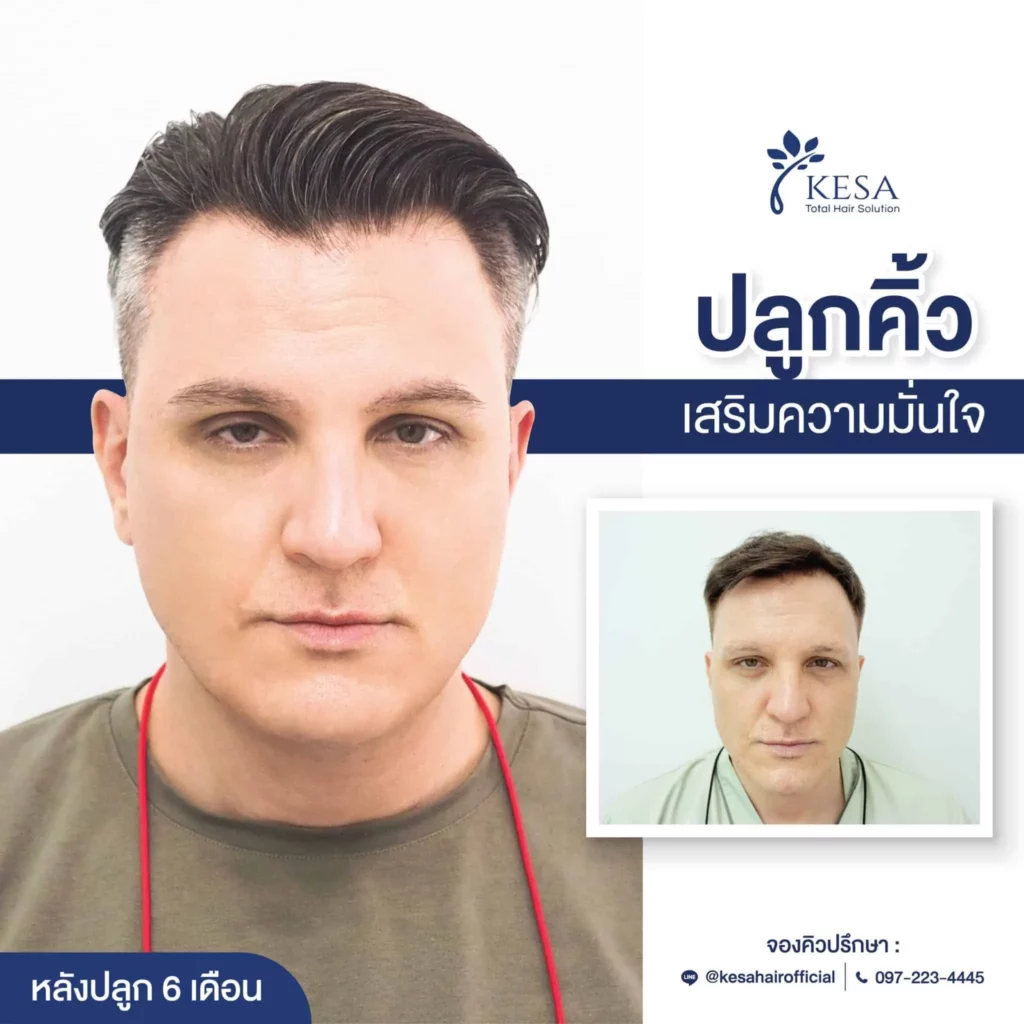 ปลูกคิ้ว ที่เกศา