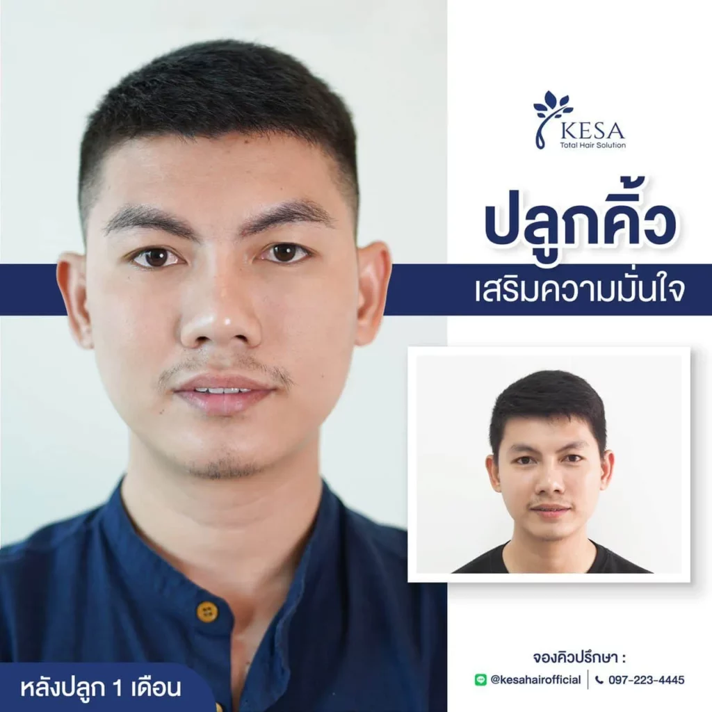 ปลูกคิ้ว ที่เกศา