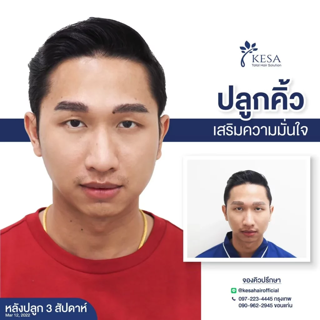 ปลูกคิ้ว ที่เกศา