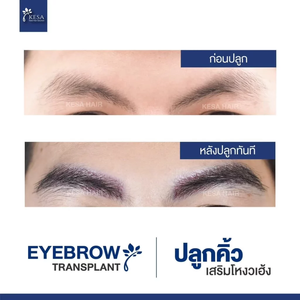 ปลูกคิ้ว ที่เกศา