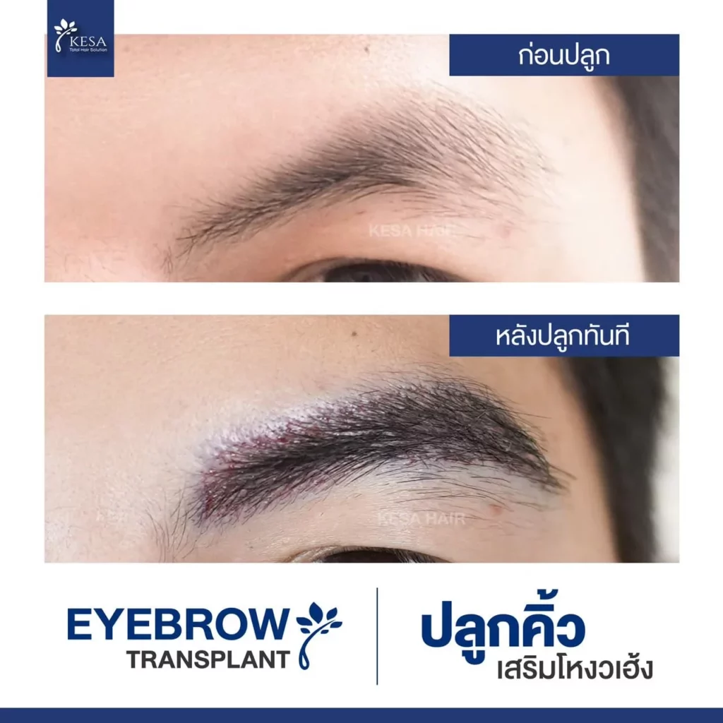 ปลูกคิ้ว ที่เกศา