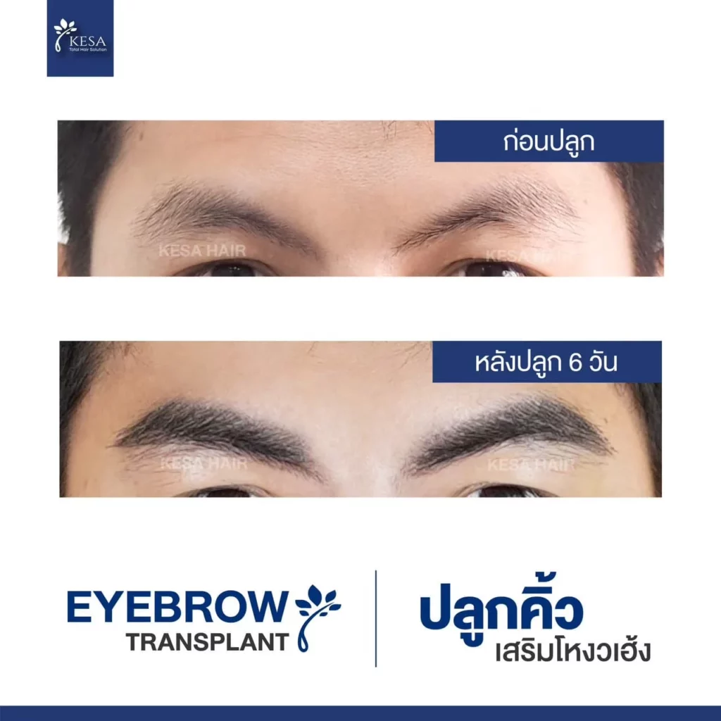 ปลูกคิ้ว ที่เกศา