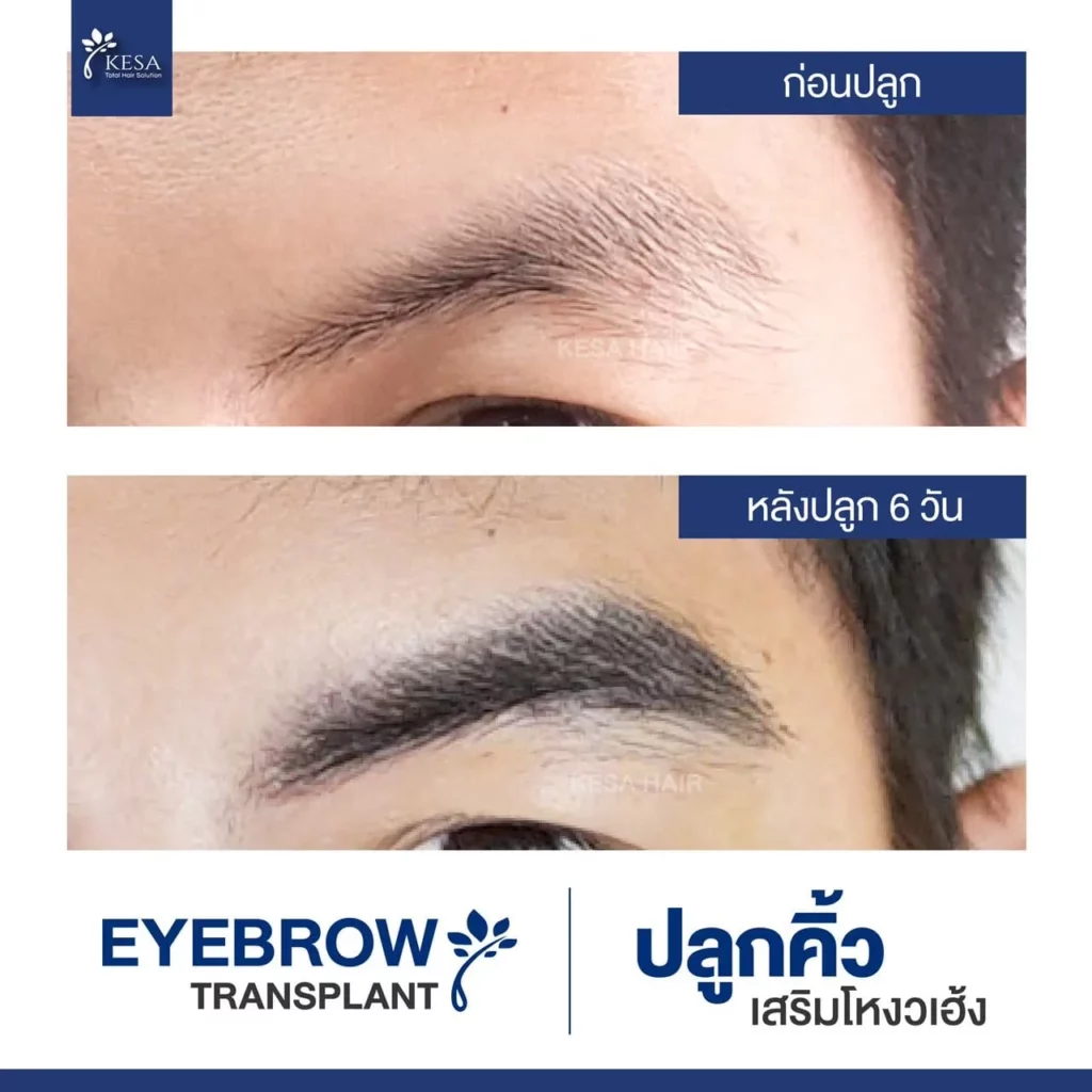 ปลูกคิ้ว ที่เกศา