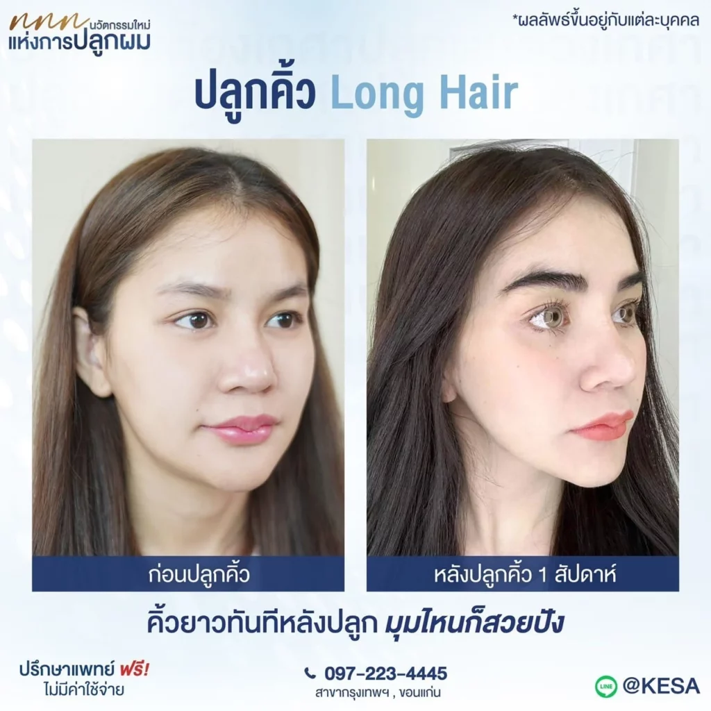 ปลูกคิ้ว ที่เกศา
