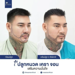 รีวิวปลูกหนวด