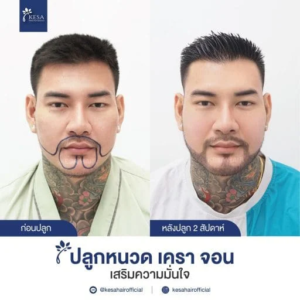 รีวิวปลูกหนวด