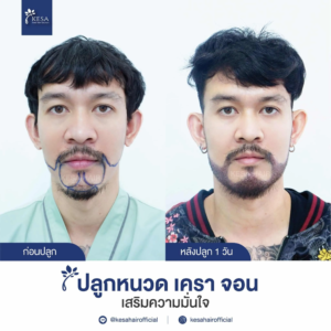 รีวิวปลูกหนวด