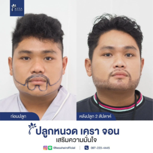 รีวิวปลูกหนวด