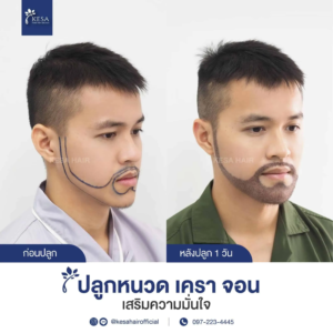 รีวิวปลูกหนวด
