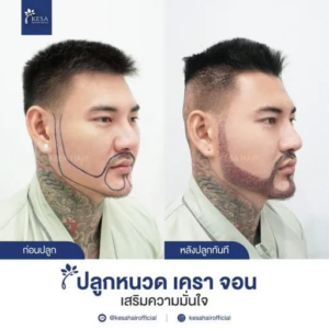 รีวิวปลูกหนวด