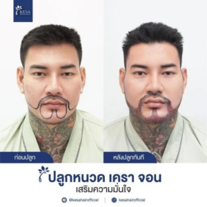 รีวิวปลูกหนวด