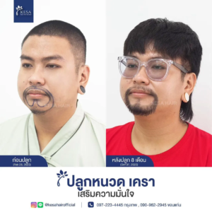 รีวิวปลูกหนวด