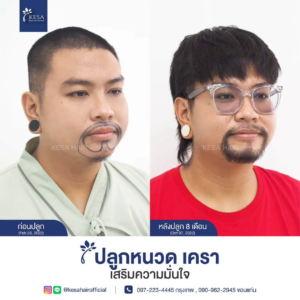 รีวิวปลูกหนวด