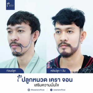 รีวิวปลูกหนวด