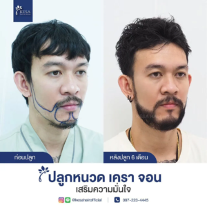 รีวิวปลูกหนวด