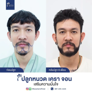 รีวิวปลูกหนวด