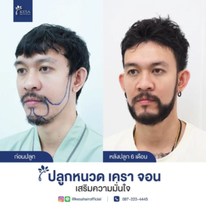 รีวิวปลูกหนวด