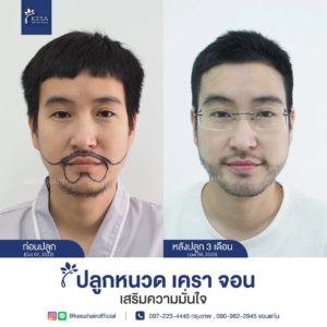 รีวิวปลูกหนวด