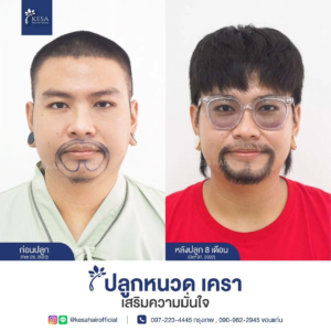 รีวิวปลูกหนวด