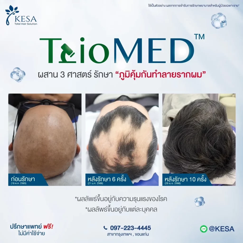 รักษาผมร่วงผมบาง triomed
