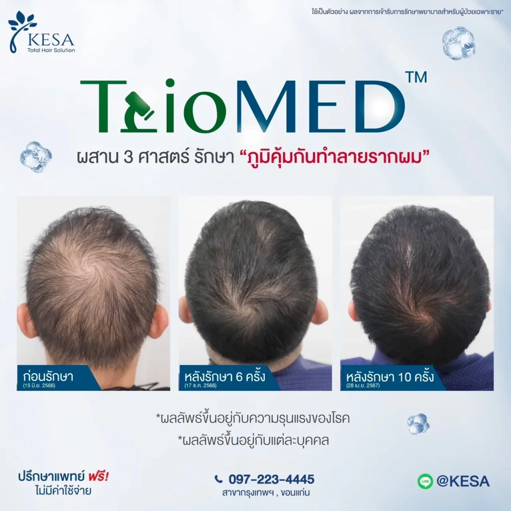 ผมบางกลางหัว เกศา คลินิก - kesa hair clinic