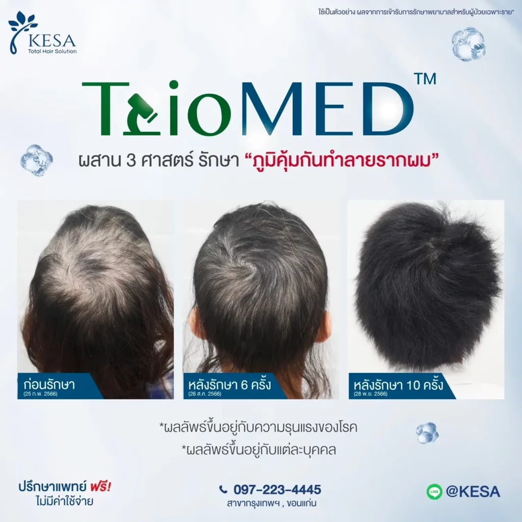 รักษาผมร่วงผมบาง triomed