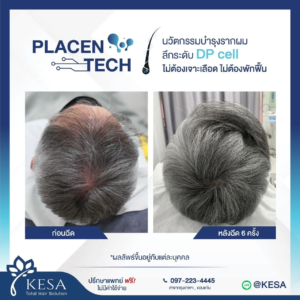 PLAZENTECH