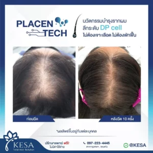 ฉีดรักษาผมบาง PLACENTECH